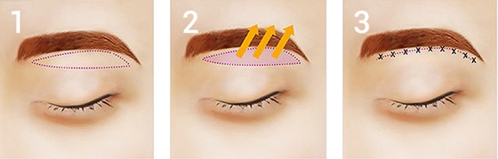 Cosmetic Surgery and Other Option: SURGERY OF THE FACE