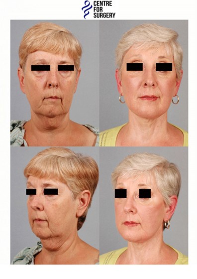 Cosmetic Surgery and Other Option: SURGERY OF THE FACE