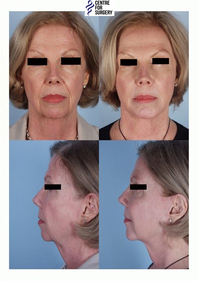 Cosmetic Surgery and Other Option: SURGERY OF THE FACE
