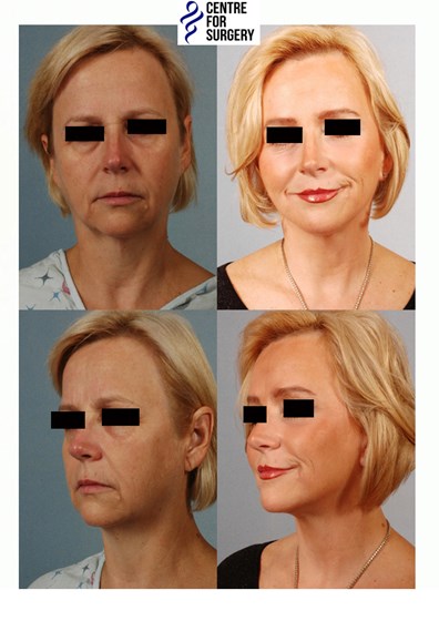Cosmetic Surgery and Other Option: SURGERY OF THE FACE
