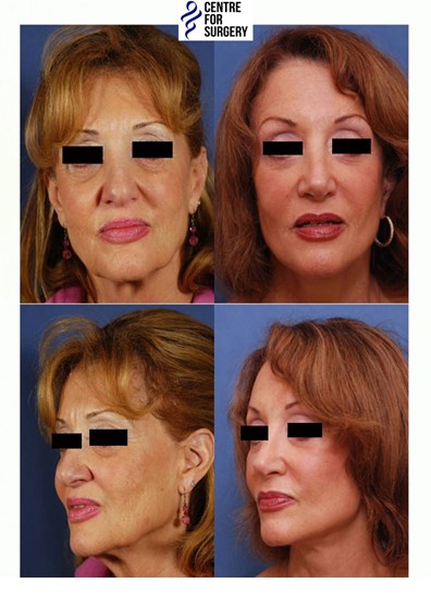 Cosmetic Surgery and Other Option: SURGERY OF THE FACE