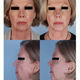 Cosmetic Surgery and Other Option: SURGERY OF THE FACE