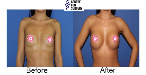 Cosmetic Surgery and Other Option: SURGERY OF THE BREAST