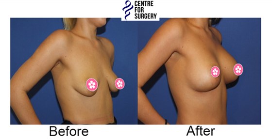 Cosmetic Surgery and Other Option: SURGERY OF THE BREAST