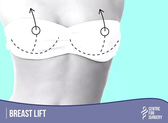 Cosmetic Surgery and Other Option: SURGERY OF THE BREAST