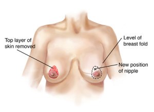 Cosmetic Surgery and Other Option: SURGERY OF THE BREAST
