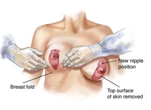 Cosmetic Surgery and Other Option: SURGERY OF THE BREAST