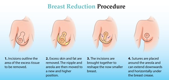 Cosmetic Surgery and Other Option: SURGERY OF THE BREAST