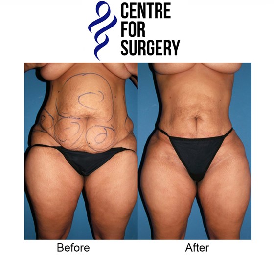 Cosmetic Surgery and Other Option: SURGERY OF THE BODY