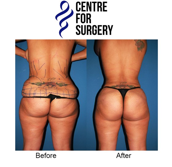 Cosmetic Surgery and Other Option: SURGERY OF THE BODY