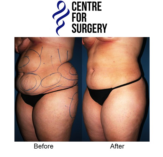 Cosmetic Surgery and Other Option: SURGERY OF THE BODY