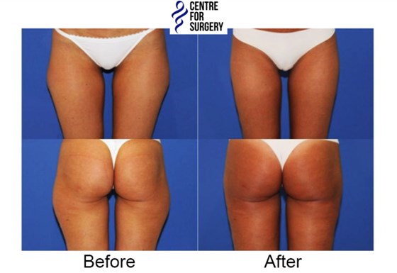 Cosmetic Surgery and Other Option: SURGERY OF THE BODY