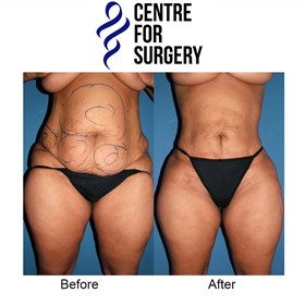 Cosmetic Surgery and Other Option: SURGERY OF THE BODY