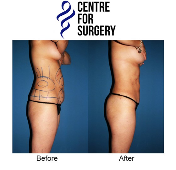Cosmetic Surgery and Other Option: PROCEDURES FOR MEN