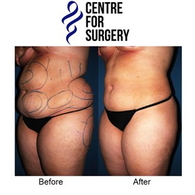 Cosmetic Surgery and Other Option: PROCEDURES FOR MEN