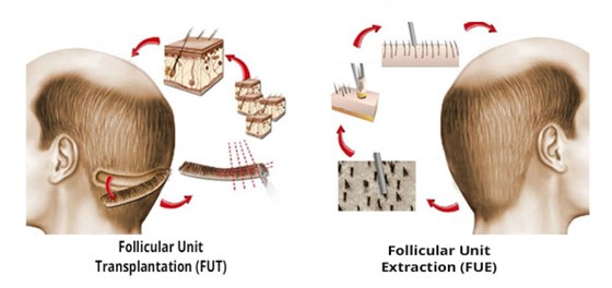 Cosmetic Surgery and Other Option: HAIR RESTORATION SURGERY