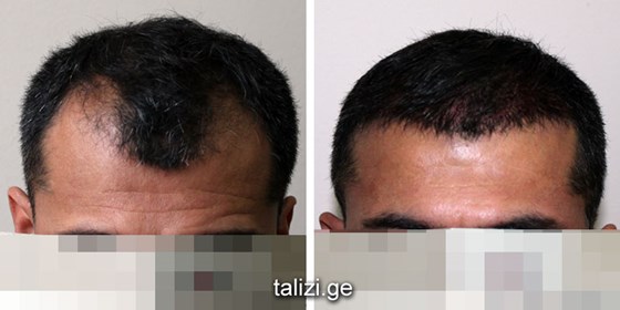 Cosmetic Surgery and Other Option: HAIR RESTORATION SURGERY