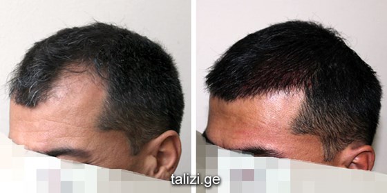 Cosmetic Surgery and Other Option: HAIR RESTORATION SURGERY