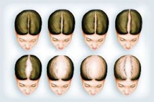 Cosmetic Surgery and Other Option: HAIR RESTORATION SURGERY