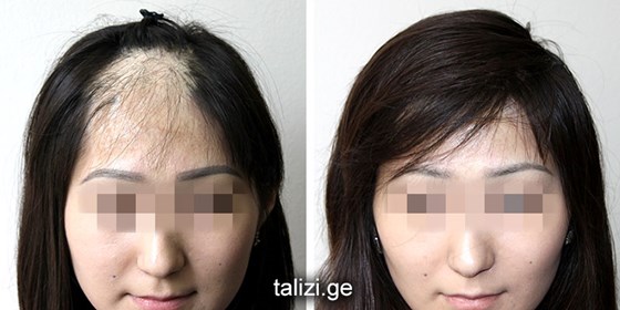 Cosmetic Surgery and Other Option: HAIR RESTORATION SURGERY