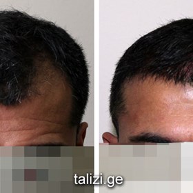 Cosmetic Surgery and Other Option: HAIR RESTORATION SURGERY